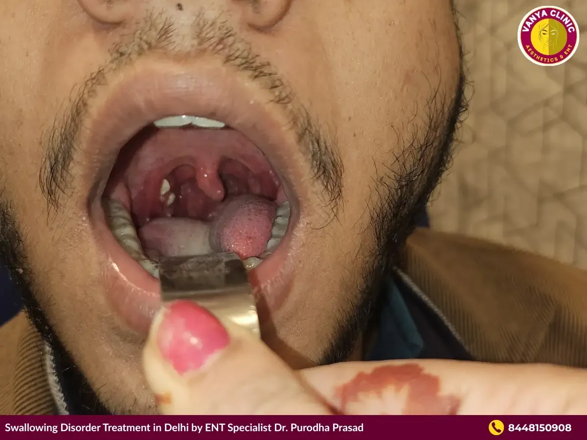 Patient's open mouth for throat inspection in Delhi.