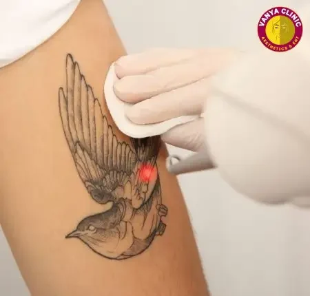 Tattoo Removal in Delhi India