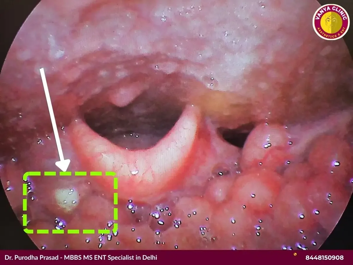 An infection inside throat.