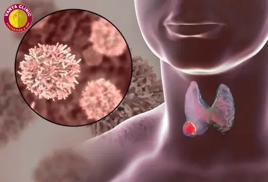 Thyroid Mass or Thyroid Cancer in Delhi