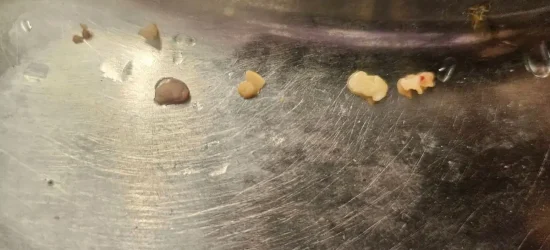 Tonsils stone removed after tonsilitis treatment in Delhi.