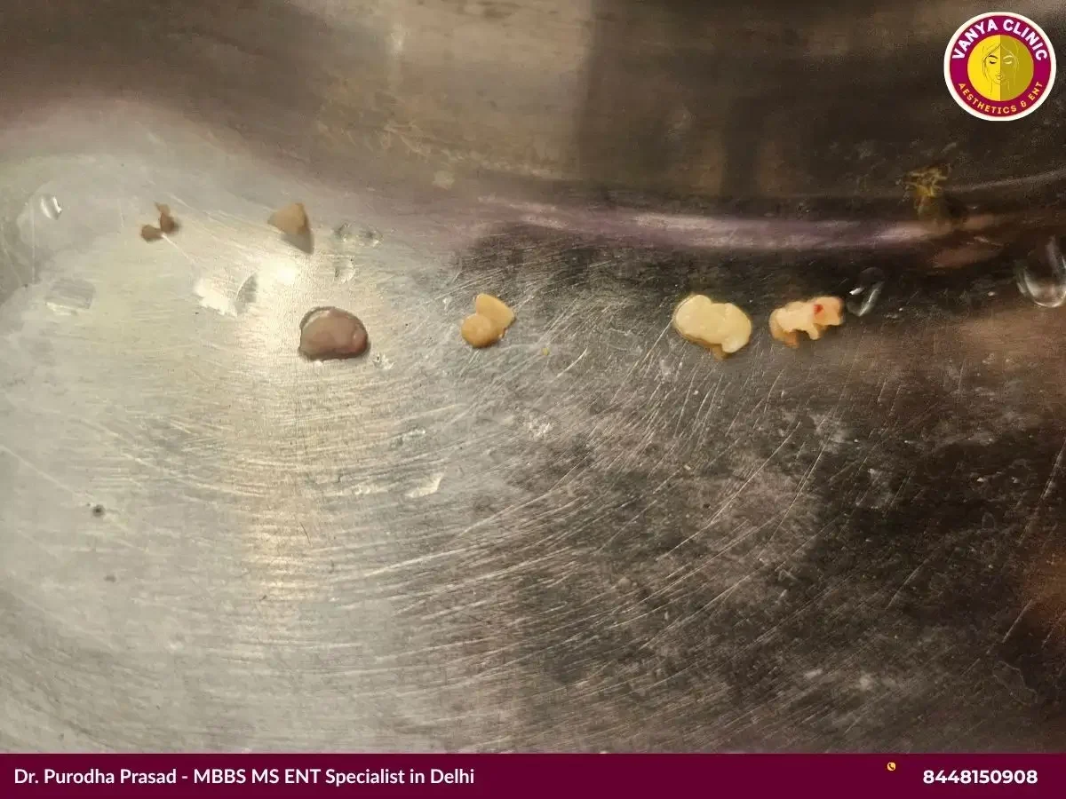Tonsils stone removed after tonsilitis treatment in Delhi.
