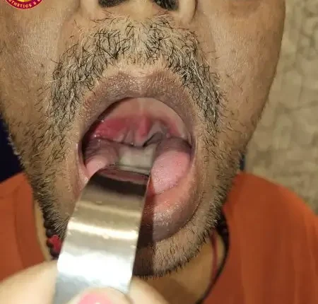 Tonsils Treatment in Delhi at Vanya Clinic