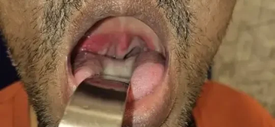 Tonsils treatment in Delhi
