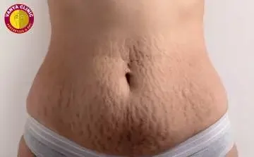 Tummy tuck Scar Removal Surgery in New Delhi Green Park