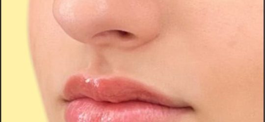 Multiple lobe and helix Nose piercing in Delhi by Dr. Purodha Prasad