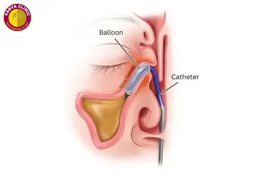 What is Ballon Sinuplasty in Delhi