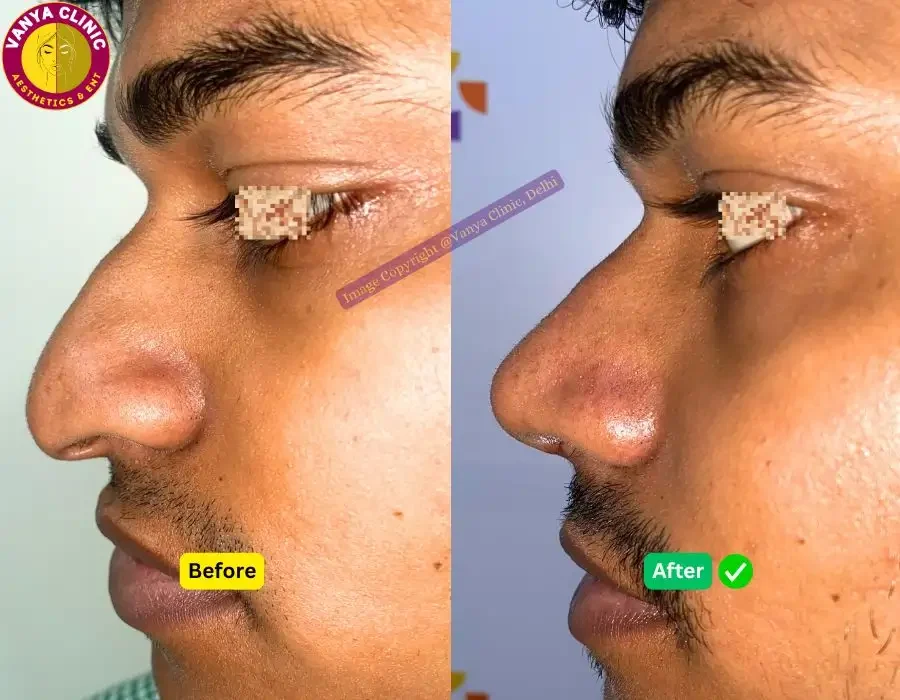 Wide Nose Rhinoplasty Before and After Photos